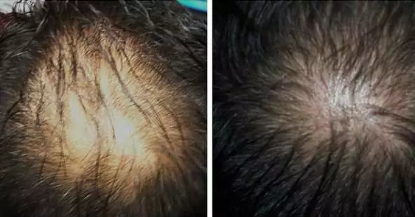 hair-growth-with-prp-treatment-2