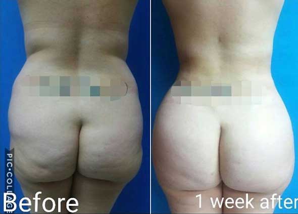 liposuction-with-fat-transfer-miami-2
