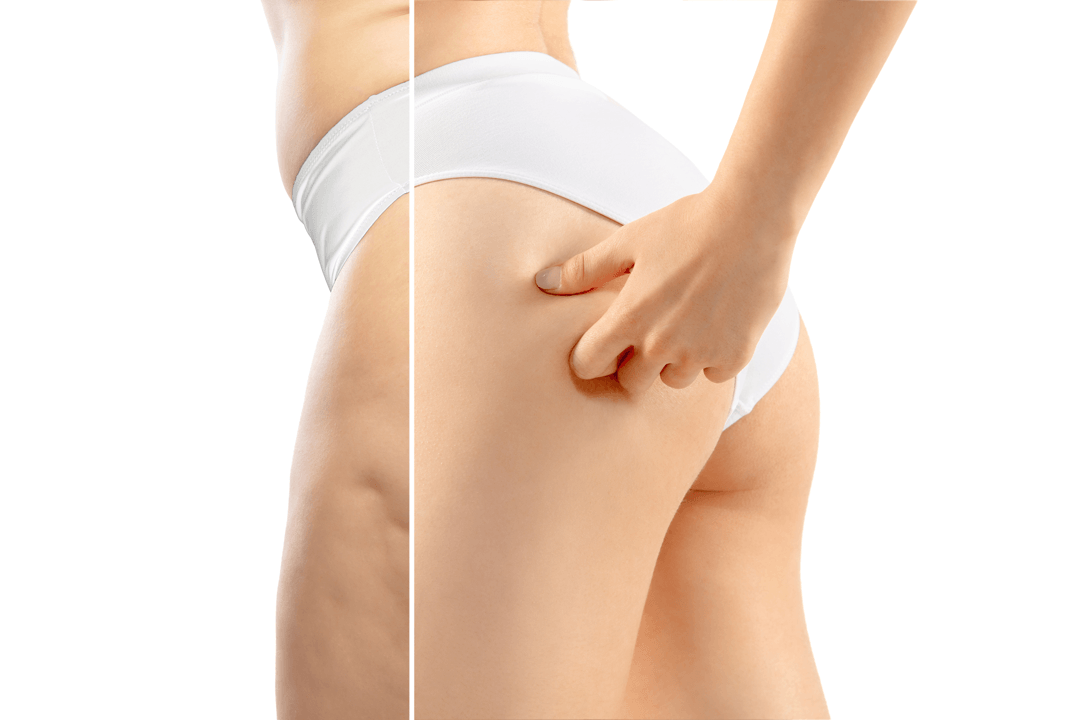 Patient discussing cellulite treatment options with a skin care clinician