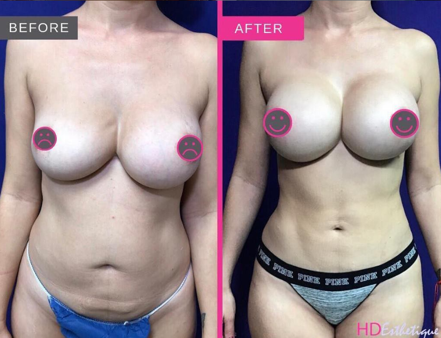 lipo before & after