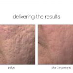 Venus Viva before and after pictures