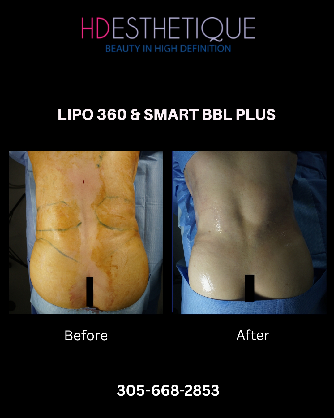 Lipo 360 with Retraction