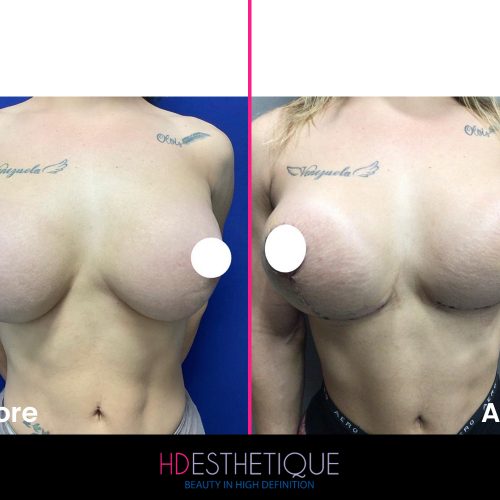 Biopolymer-Removal-1