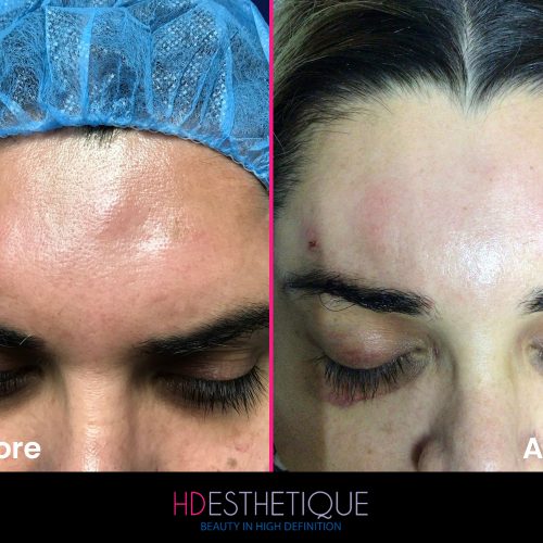 Biopolymer-Removal-4