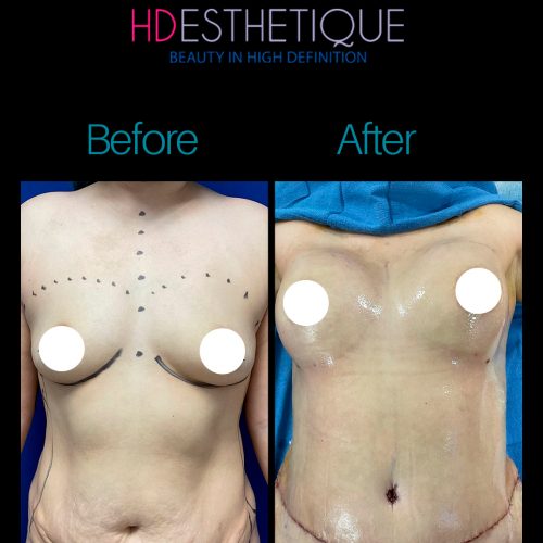 Check out the natural and transformative results from this Tummy Tuck surgery. For a free consul (1)