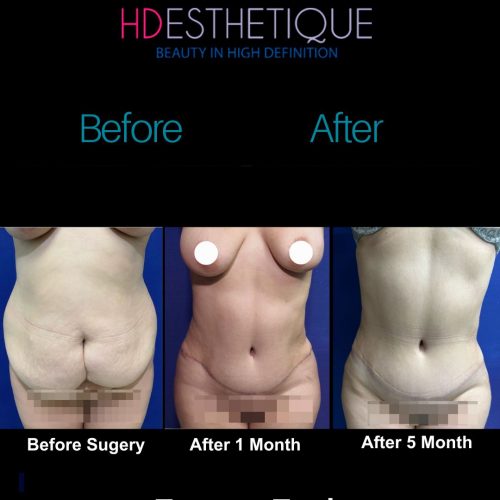 Check out the natural and transformative results from this Tummy Tuck surgery. For a free consul
