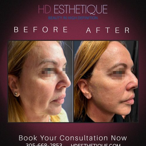 Check out the results of this face and neck lift❤️😍If you are ready to experience how our Miam