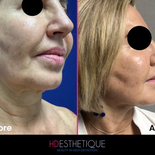 Facelift Miami florida-1