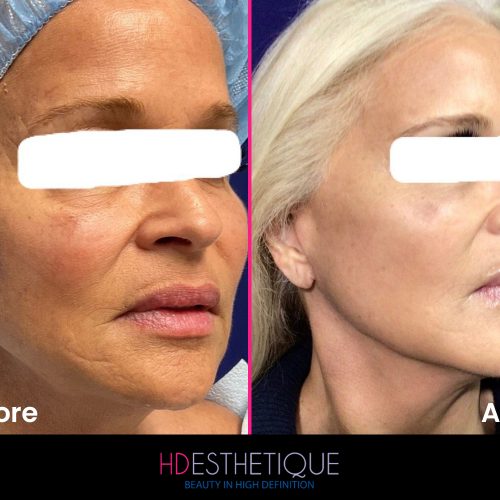 Facelift Miami florida-2