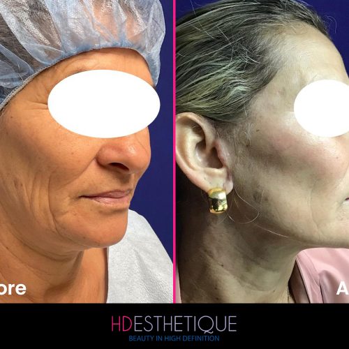 Facelift Miami florida-3