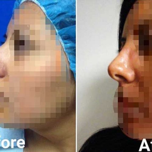 rhinoplasty services