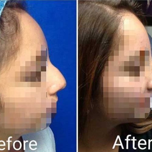 rhinoplasty services